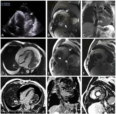 Multimodal imaging features of primary pericardial synovial sarcoma: a case report